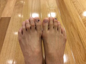 ランニングでできた足の爪の血豆